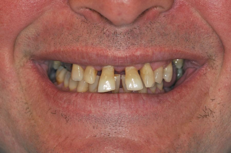 teeth in a day - before